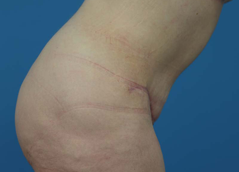 Abdominoplasty Before and After | Dr Evan W Beale