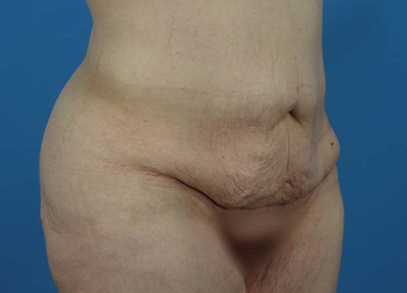 Abdominoplasty Before and After | Dr Evan W Beale