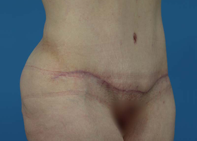 Abdominoplasty Before and After | Dr Evan W Beale