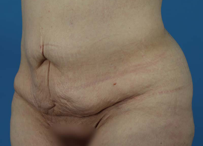 Abdominoplasty Before and After | Dr Evan W Beale