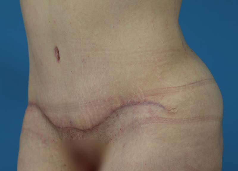 Abdominoplasty Before and After | Dr Evan W Beale