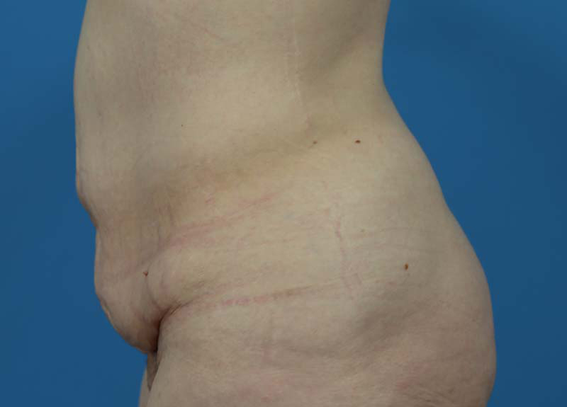 Abdominoplasty Before and After | Dr Evan W Beale