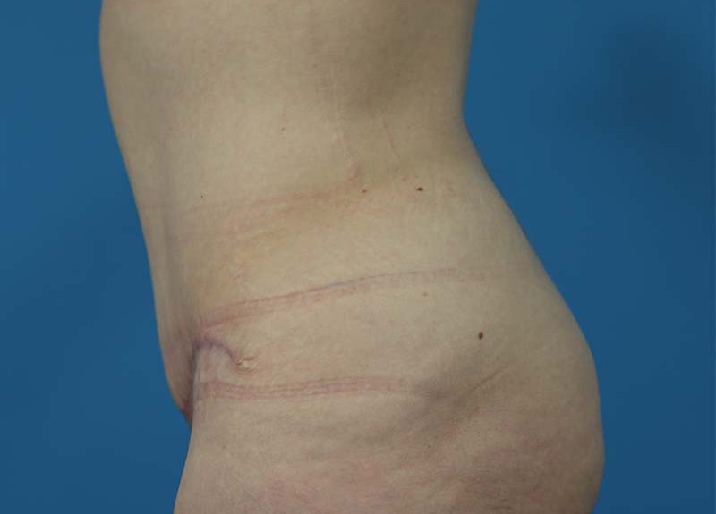 Abdominoplasty Before and After | Dr Evan W Beale