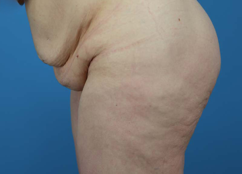 Abdominoplasty Before and After | Dr Evan W Beale