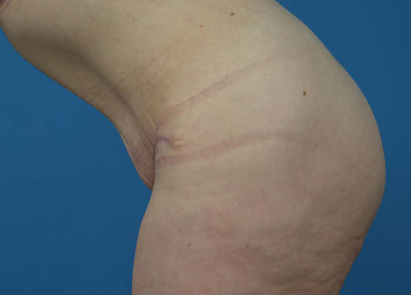 Abdominoplasty Before and After | Dr Evan W Beale