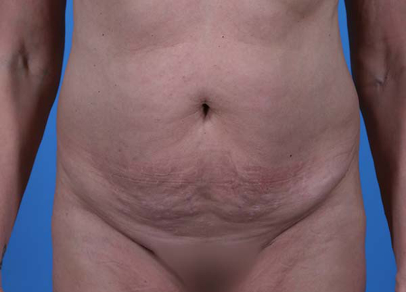 Abdominoplasty Before and After | Dr Evan W Beale