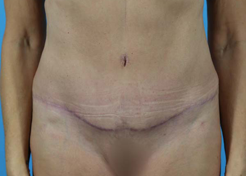 Abdominoplasty Before and After | Dr Evan W Beale