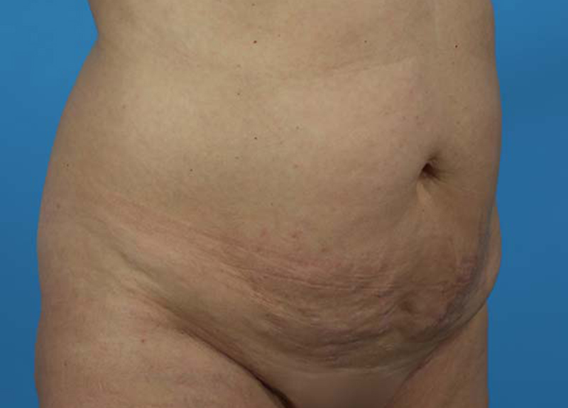 Abdominoplasty Before and After | Dr Evan W Beale