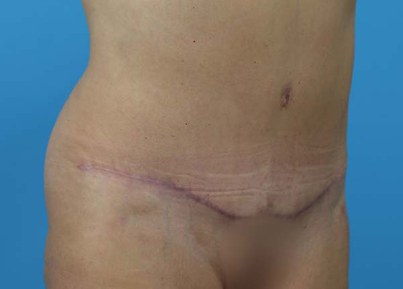 Abdominoplasty Before and After | Dr Evan W Beale