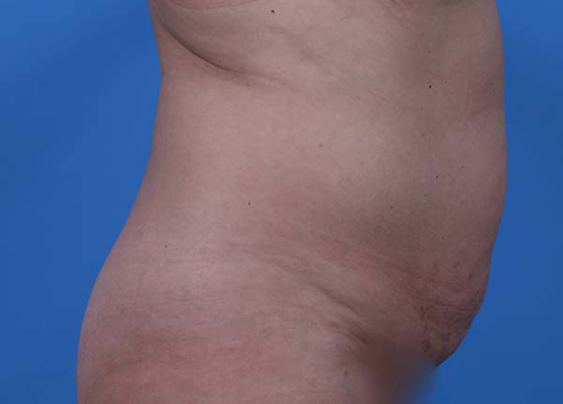 Abdominoplasty Before and After | Dr Evan W Beale