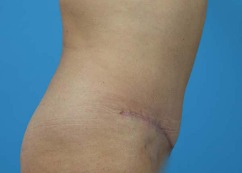 Abdominoplasty Before and After | Dr Evan W Beale
