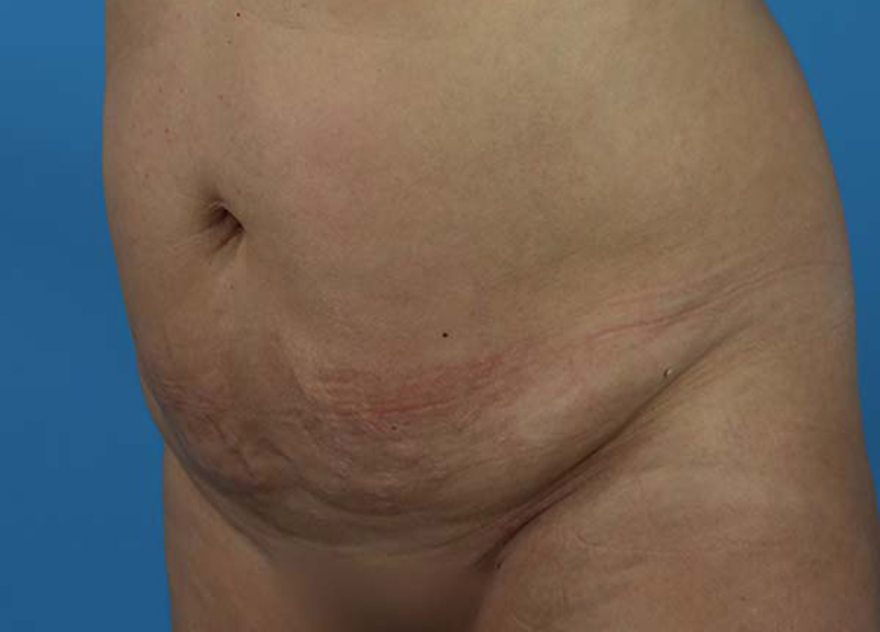 Abdominoplasty Before and After | Dr Evan W Beale