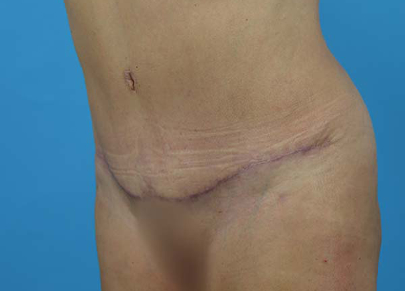 Abdominoplasty Before and After | Dr Evan W Beale
