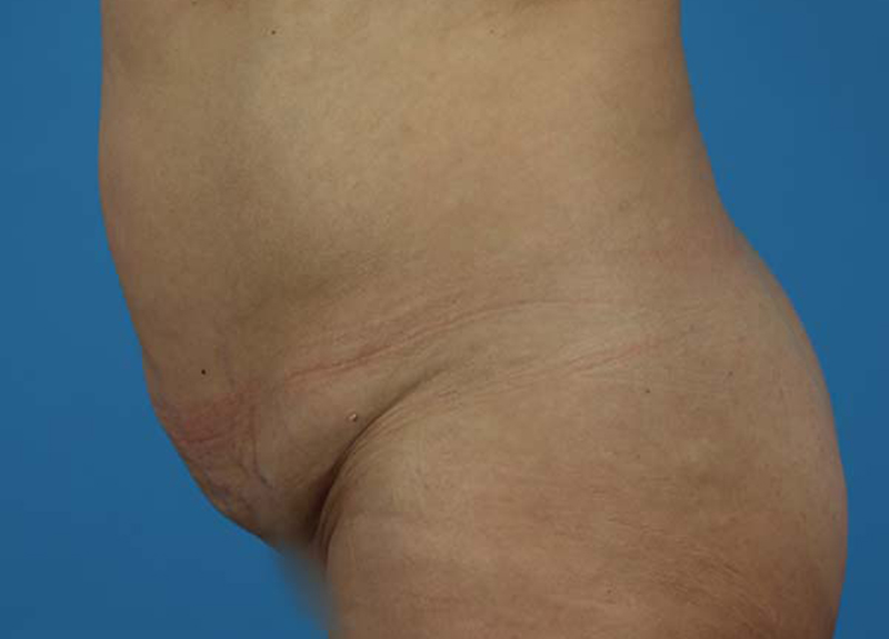 Abdominoplasty Before and After | Dr Evan W Beale