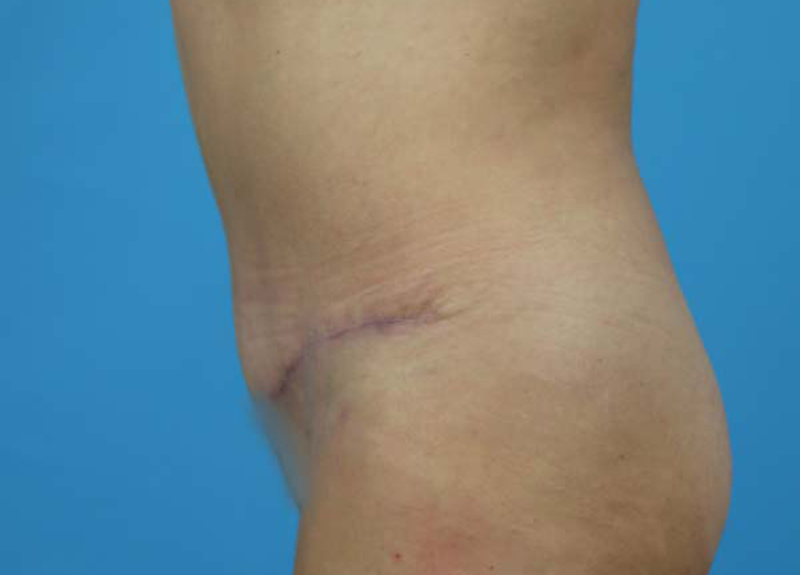 Abdominoplasty Before and After | Dr Evan W Beale