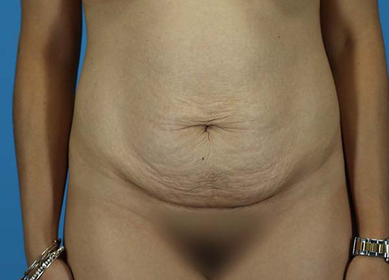 Abdominoplasty Before and After | Dr Evan W Beale