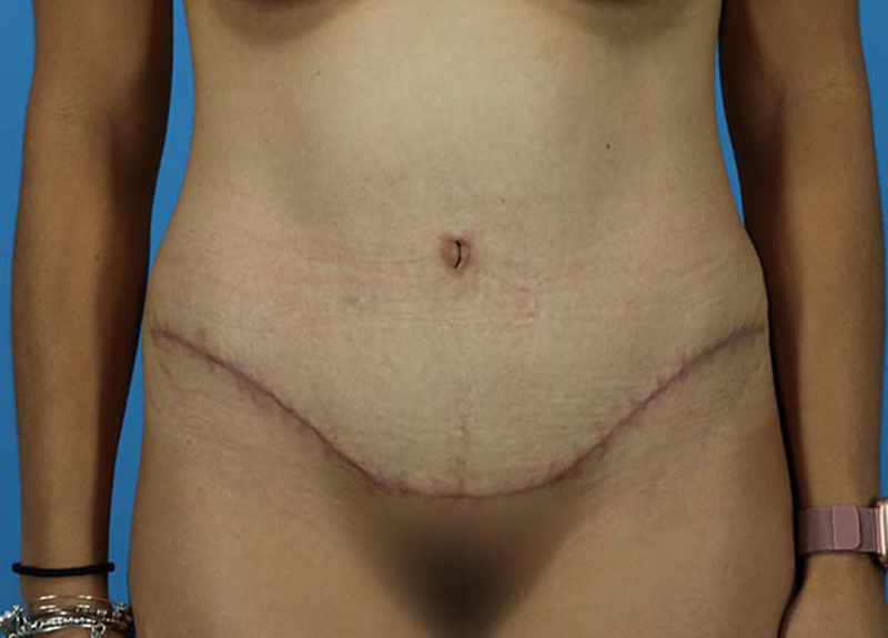 Abdominoplasty Before and After | Dr Evan W Beale