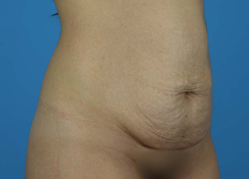 Abdominoplasty Before and After | Dr Evan W Beale
