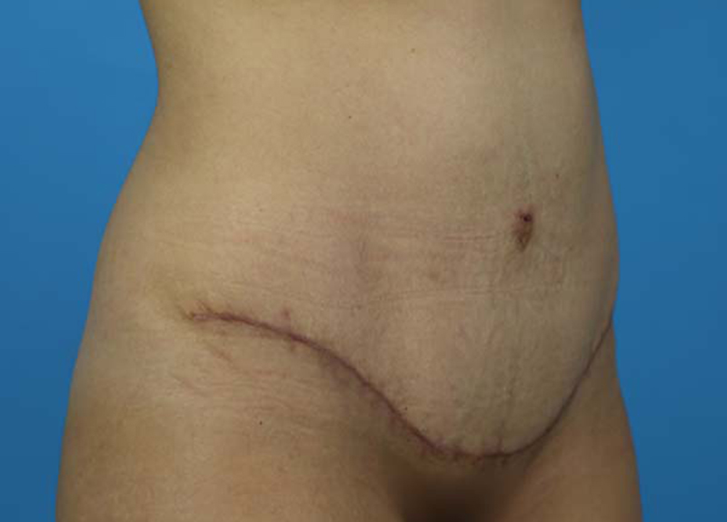 Abdominoplasty Before and After | Dr Evan W Beale