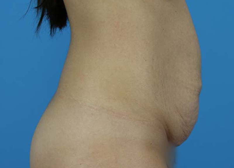 Abdominoplasty Before and After | Dr Evan W Beale