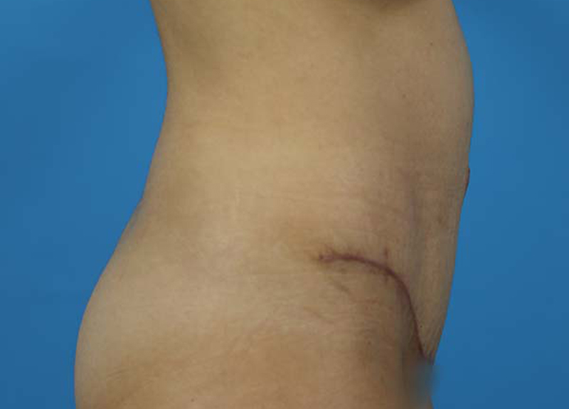 Abdominoplasty Before and After | Dr Evan W Beale