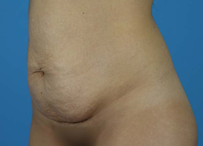 Abdominoplasty Before and After | Dr Evan W Beale