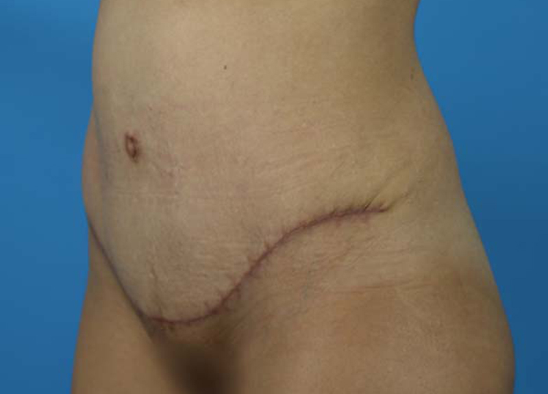 Abdominoplasty Before and After | Dr Evan W Beale