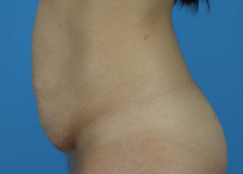 Abdominoplasty Before and After | Dr Evan W Beale