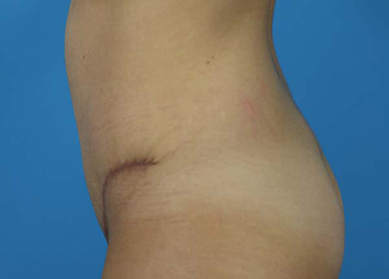 Abdominoplasty Before and After | Dr Evan W Beale