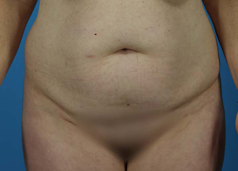 Abdominoplasty Before and After | Dr Evan W Beale