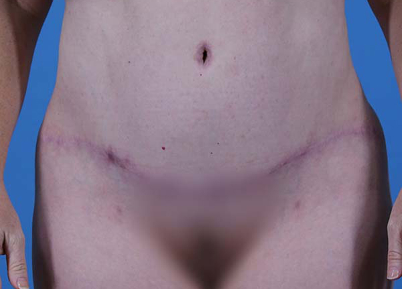 Abdominoplasty Before and After | Dr Evan W Beale