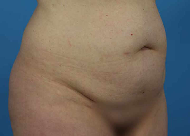 Abdominoplasty Before and After | Dr Evan W Beale