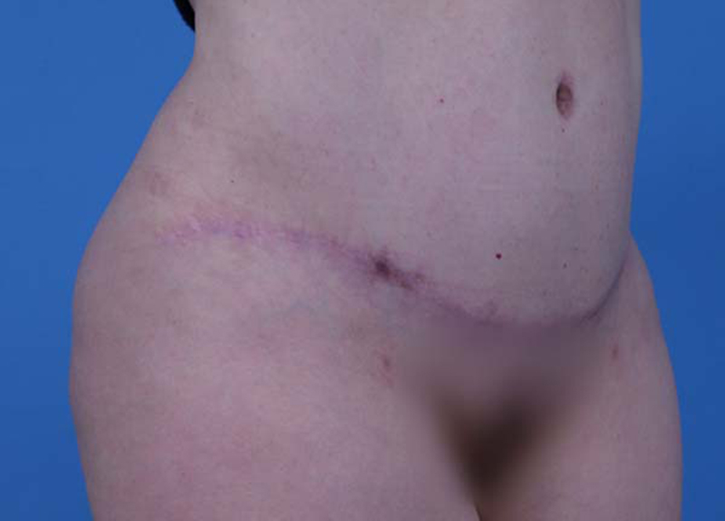 Abdominoplasty Before and After | Dr Evan W Beale