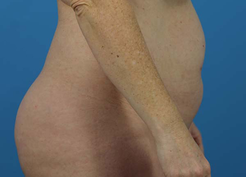 Abdominoplasty Before and After | Dr Evan W Beale