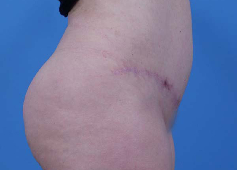 Abdominoplasty Before and After | Dr Evan W Beale