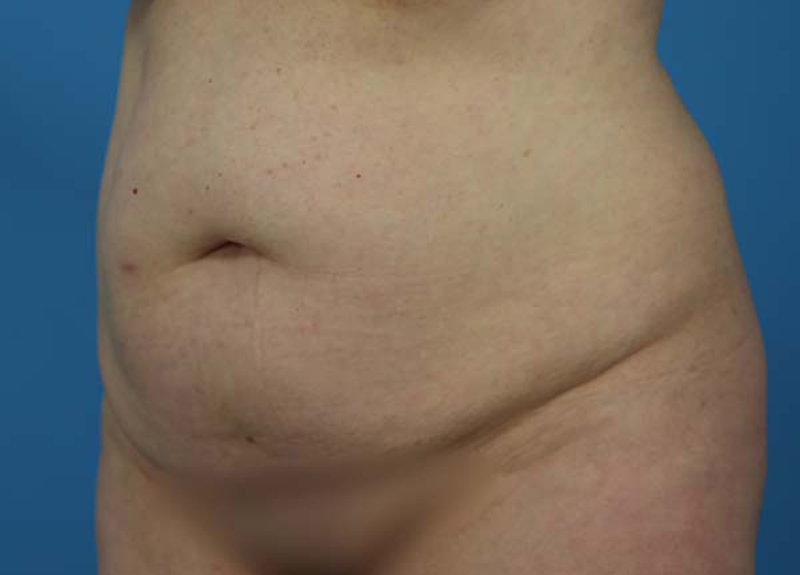 Abdominoplasty Before and After | Dr Evan W Beale