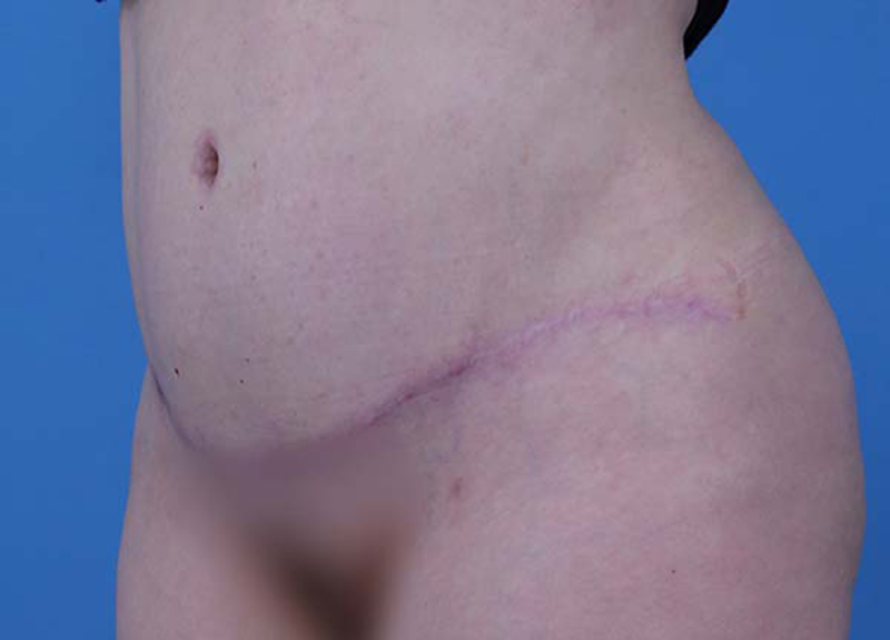 Abdominoplasty Before and After | Dr Evan W Beale