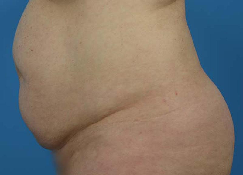 Abdominoplasty Before and After | Dr Evan W Beale