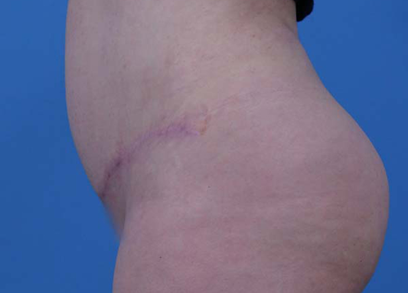 Abdominoplasty Before and After | Dr Evan W Beale