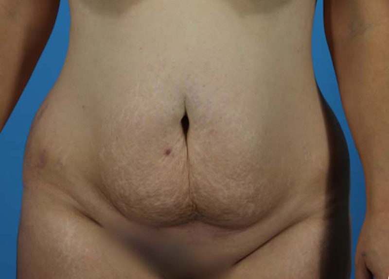 Abdominoplasty Before and After | Dr Evan W Beale