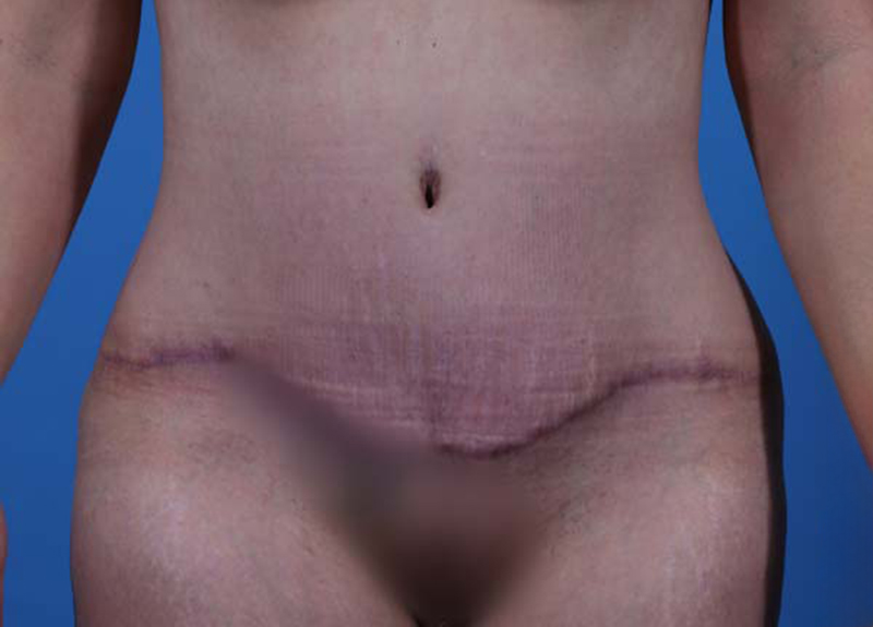 Abdominoplasty Before and After | Dr Evan W Beale