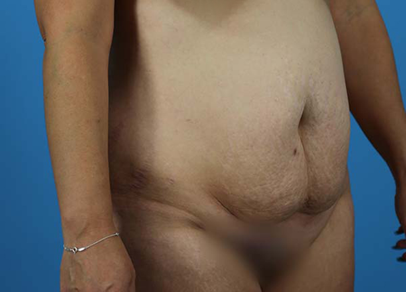 Abdominoplasty Before and After | Dr Evan W Beale