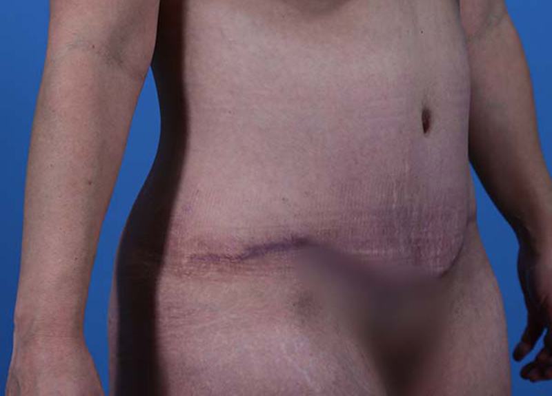 Abdominoplasty Before and After | Dr Evan W Beale