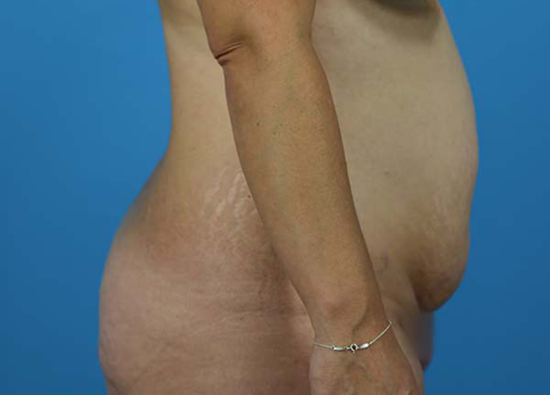 Abdominoplasty Before and After | Dr Evan W Beale