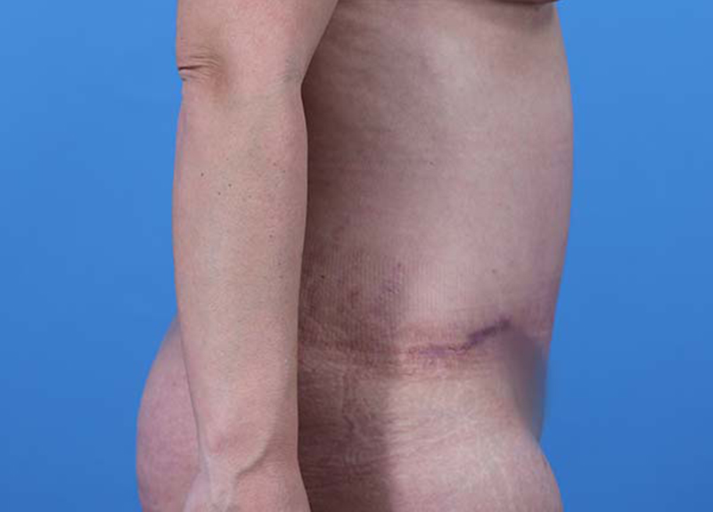 Abdominoplasty Before and After | Dr Evan W Beale