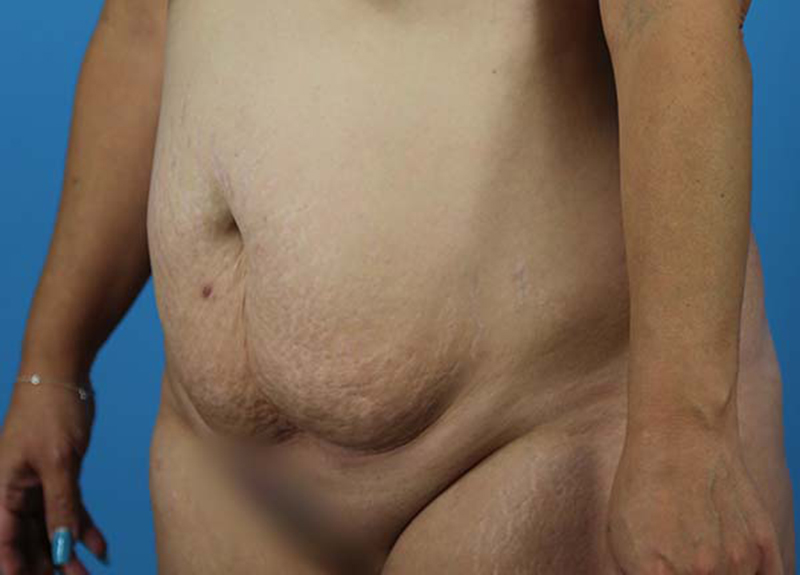 Abdominoplasty Before and After | Dr Evan W Beale