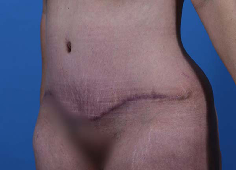 Abdominoplasty Before and After | Dr Evan W Beale