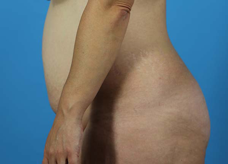 Abdominoplasty Before and After | Dr Evan W Beale