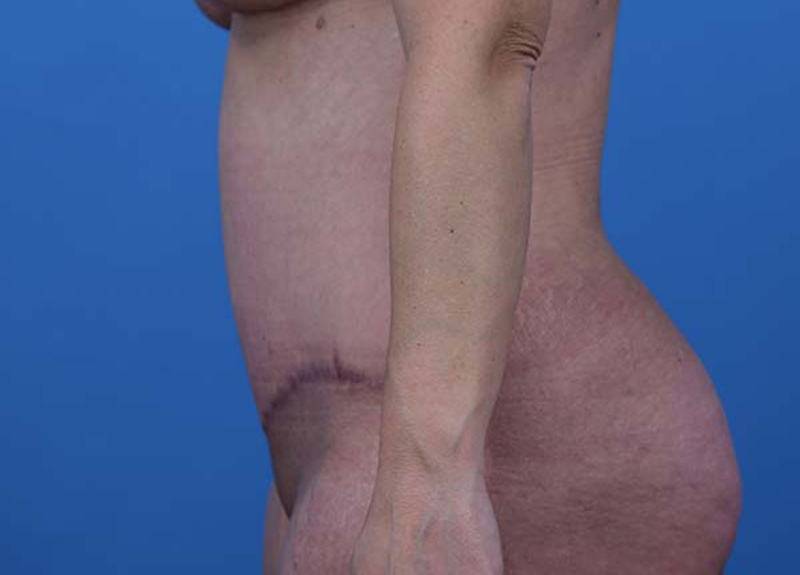 Abdominoplasty Before and After | Dr Evan W Beale