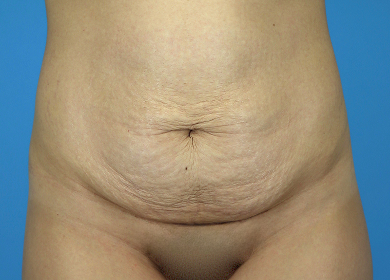 Abdominoplasty Before and After | Dr Evan W Beale